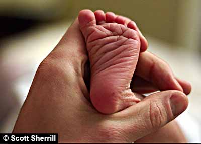 Newborn foot with cutaneous folds