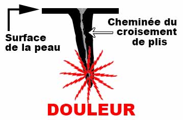 Douleur dans un croisement de plis