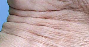 Folds on a the wrist