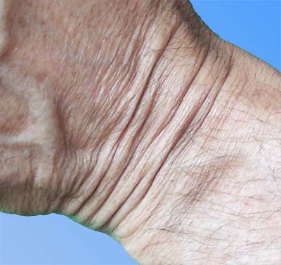 Folds on the wrist