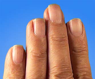 Human flat nails