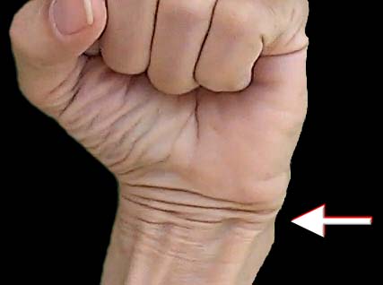 Permanent folds on wrist